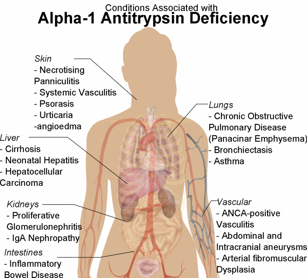 Alpha 1 Antitrypsin Deficiency Condition