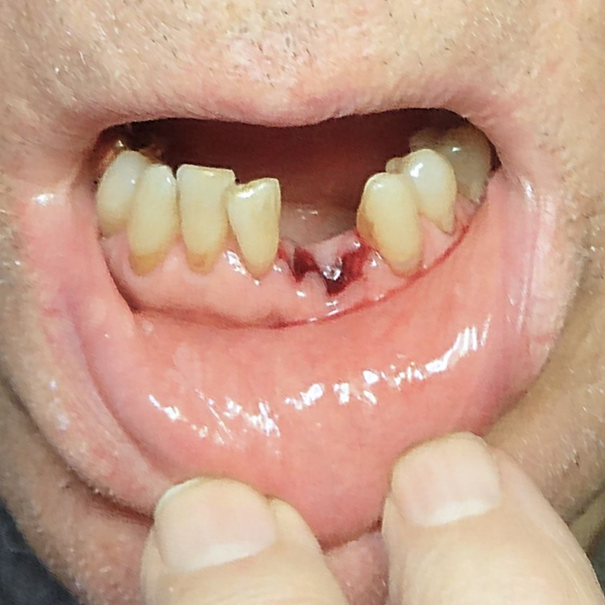 Alveolar Osteitis (Dry Socket Overview)