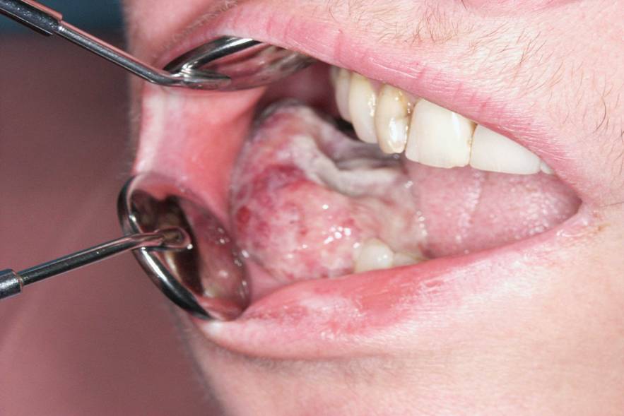 Alveolus Cancer (Oral Cancer)