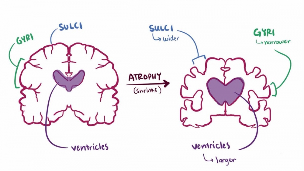 Alzheimer's Disease Causes, Stages, and Symptoms