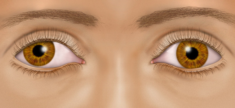 Amblyopia