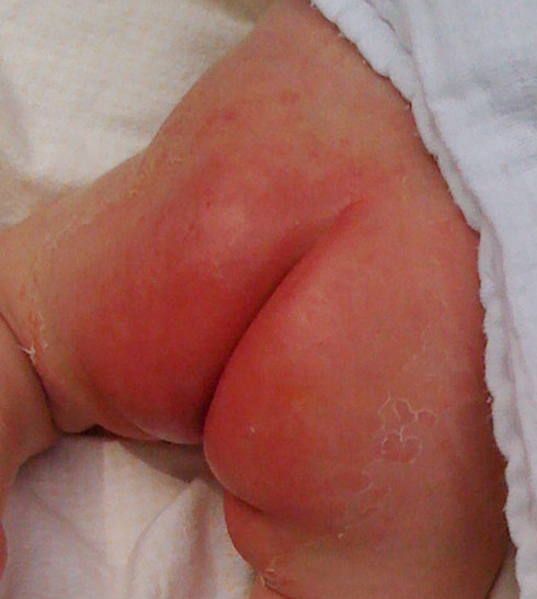 Ammonia Rash (Diaper Rash)