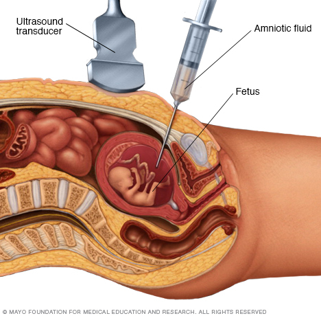 Amniocentesis