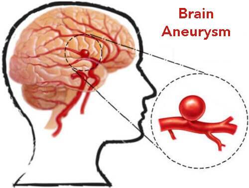 Aneurysm (Brain Aneurysm)