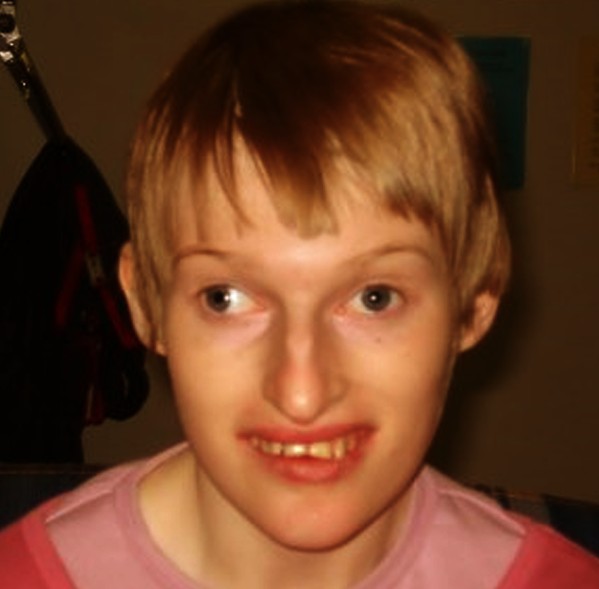 Angelman Syndrome