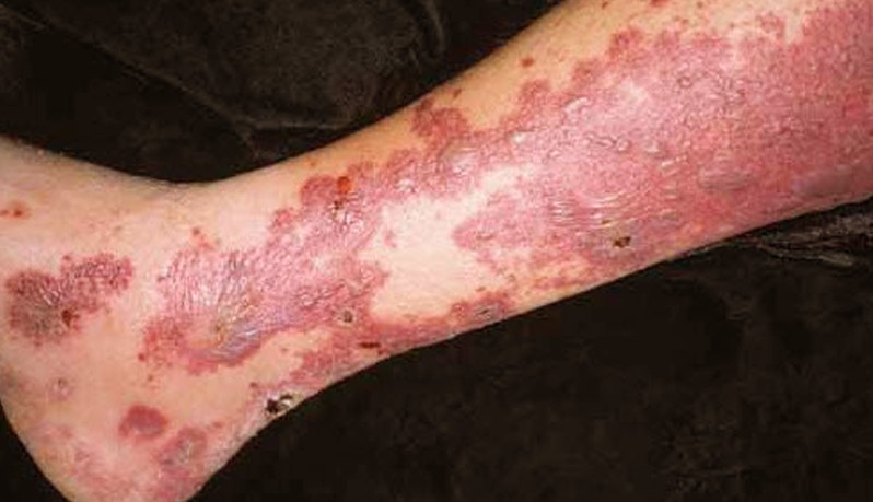 Angiitis (Vasculitis)