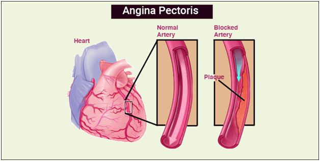 Angina Pectoris