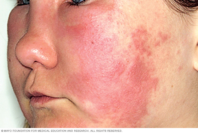 Angioedema (Hives)