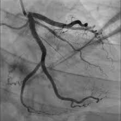 Angiogram Of Heart (Coronary Angiogram)