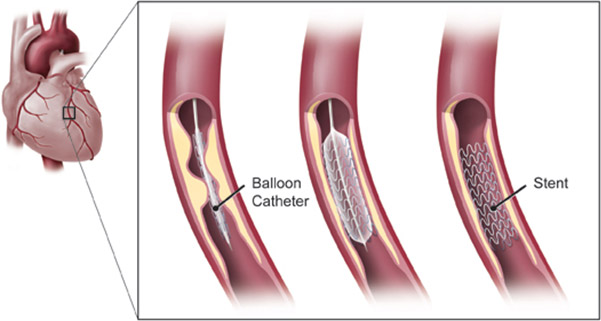 Angioplasty (Coronary Angioplasty)