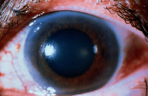 Angle Closure Glaucoma (Glaucoma)