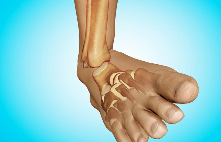 Ankle Dislocation (Dislocated Ankle (Ankle Dislocation))