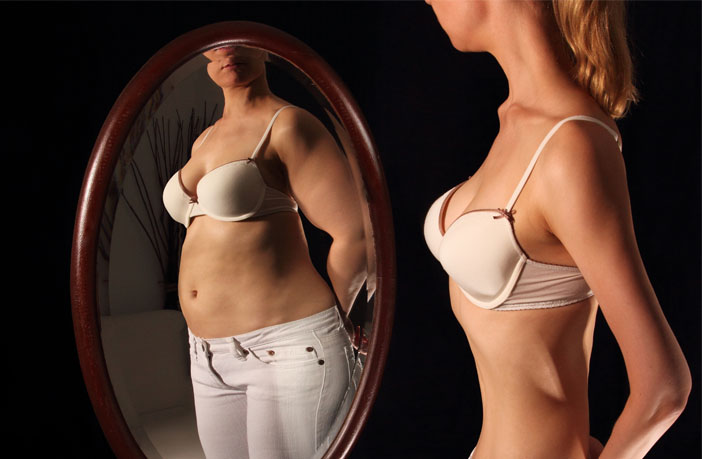 Anorexia Nervosa