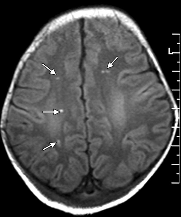 Anoxia Encephalopathy (Encephalopathy)