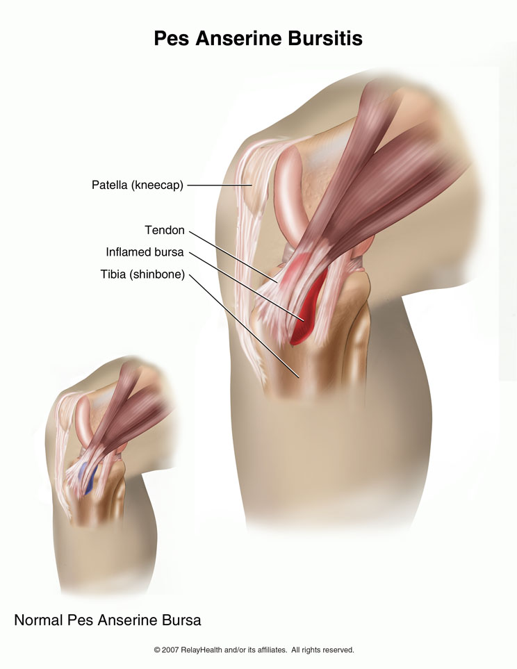 Anserine Bursitis (Knee Bursitis)