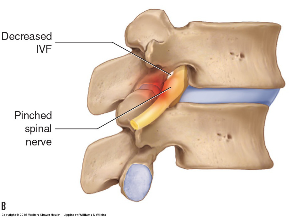 Anterolisthesis (Spondylolisthesis)