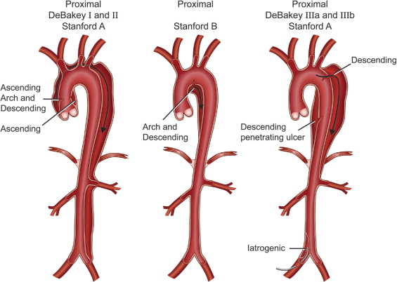 Aortic Dissection