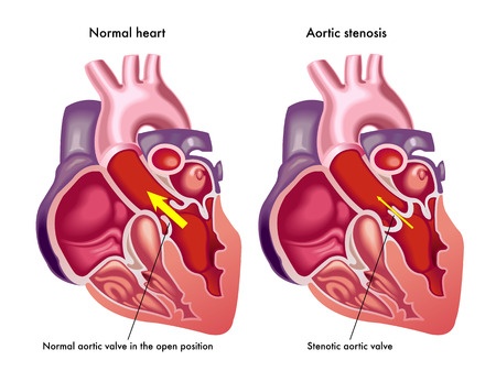 Aortic Stenosis