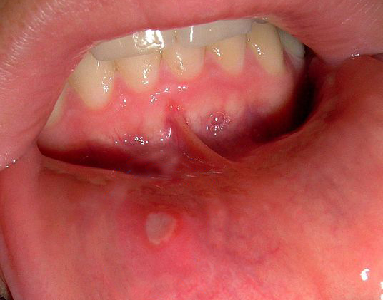 Aphthous Ulcers (Canker Sores)