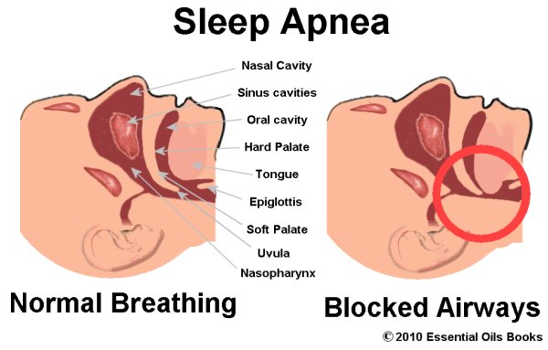 Apnea, Sleep (Sleep Apnea)
