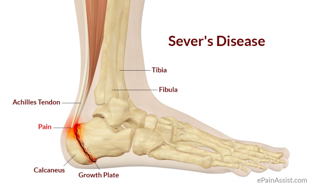 Apophysitis Calcaneus (Sever Condition)
