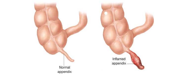 Appendicitis