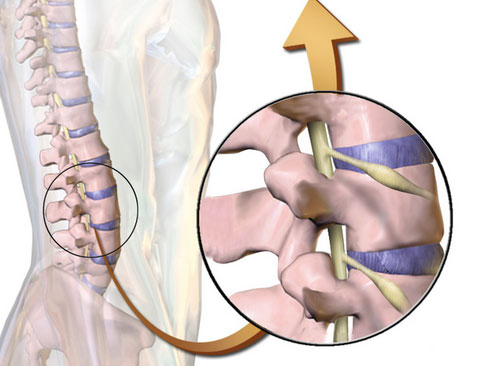 Arachnoiditis