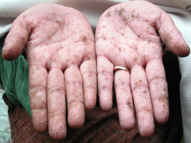Arsenic Poisoning
