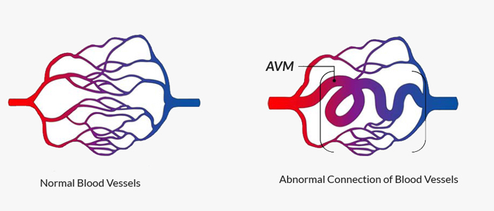 Arteriovenous Malformation