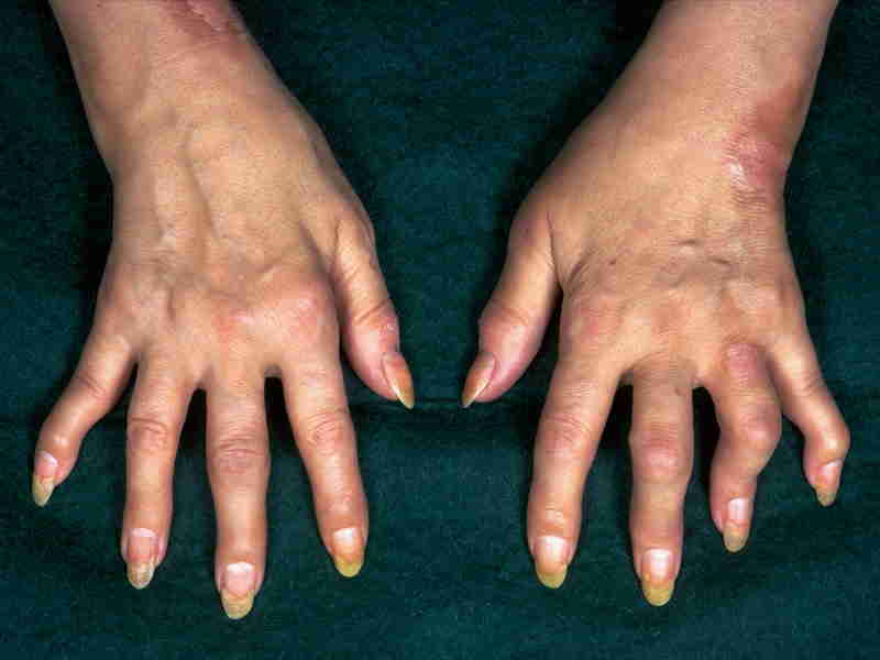 Arthralgia (Arthritis)