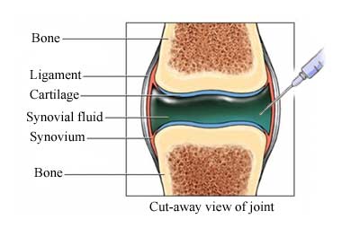 Arthrocentesis (Joint Aspiration)