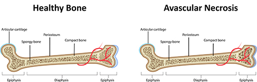 Aseptic Necrosis