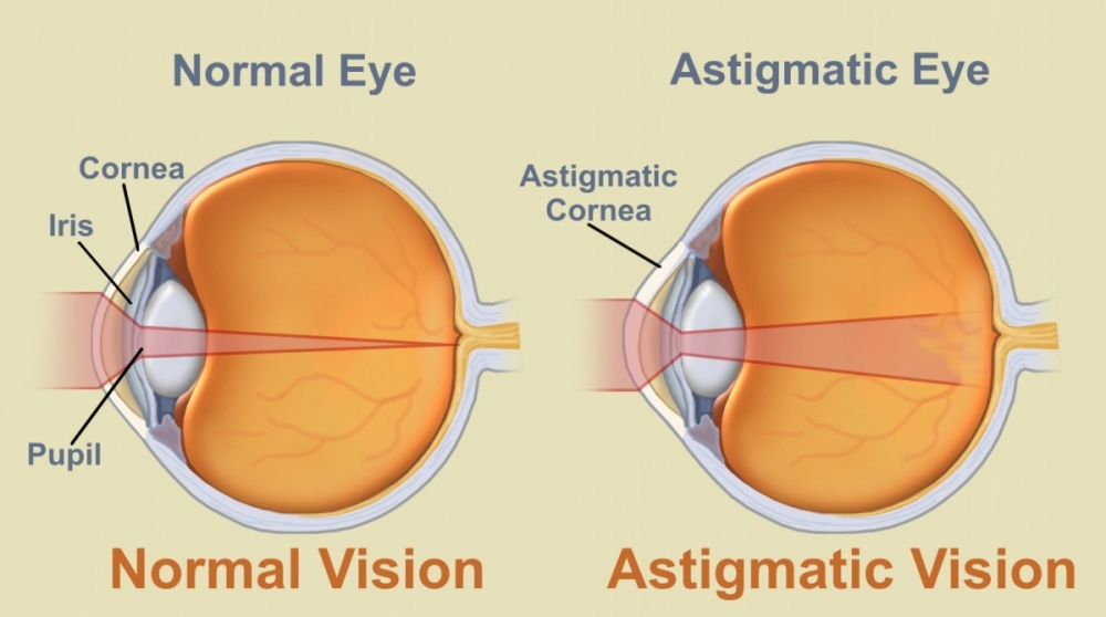Astigmatism