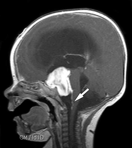 Astrocytoma (Brain Tumor)