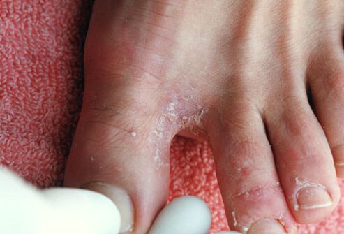 Athlete Foot (Athlete's Foot)