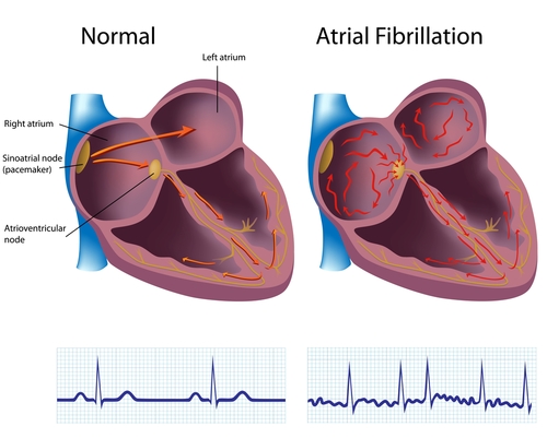 Atrial Fib (Atrial Fibrillation)