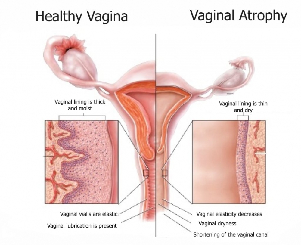 Atrophy, Vaginal (Vaginal Dryness and Vaginal Atrophy)