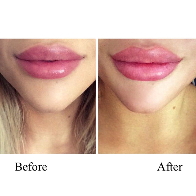 Augmentation, Lip (Lip Augmentation)