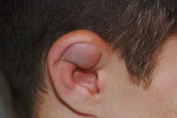 Aural Hematoma (Hematoma)