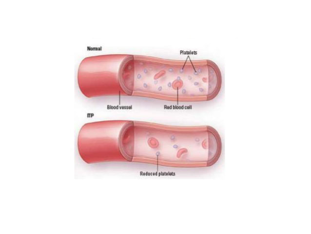 Autoimmune Thrombocytopenic Purpura (Idiopathic Thrombocytopenic Purpura (ITP))