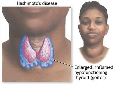 Autoimmune Thyroid Disease (Hashimoto's Thyroiditis)