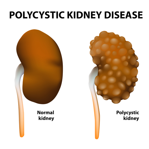 Autosomal Dominant PKD (Polycystic Kidney Disease)
