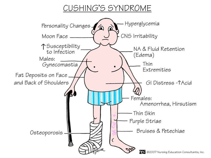 Cushing's Syndrome