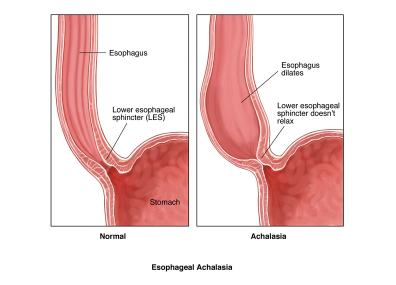 Esophageal Achalasia large