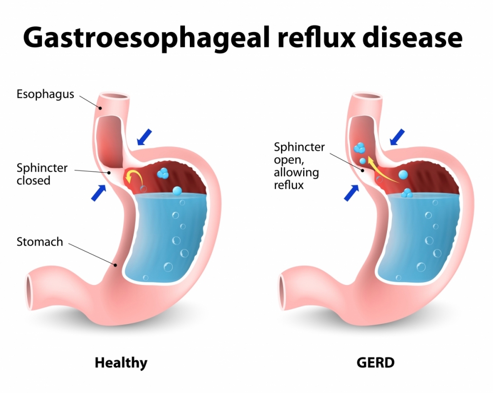 Gastroesophageal Reflux Disease GRED