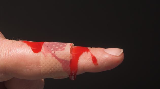 Hemophilia A