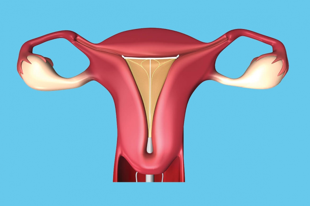 Novasure Endometrial Ablation
